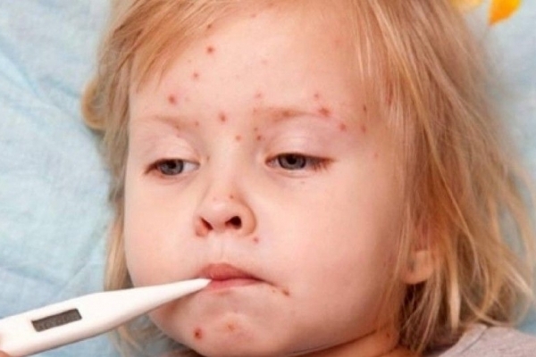 Як в Тернополі немовлят від кору лікують (Відео)